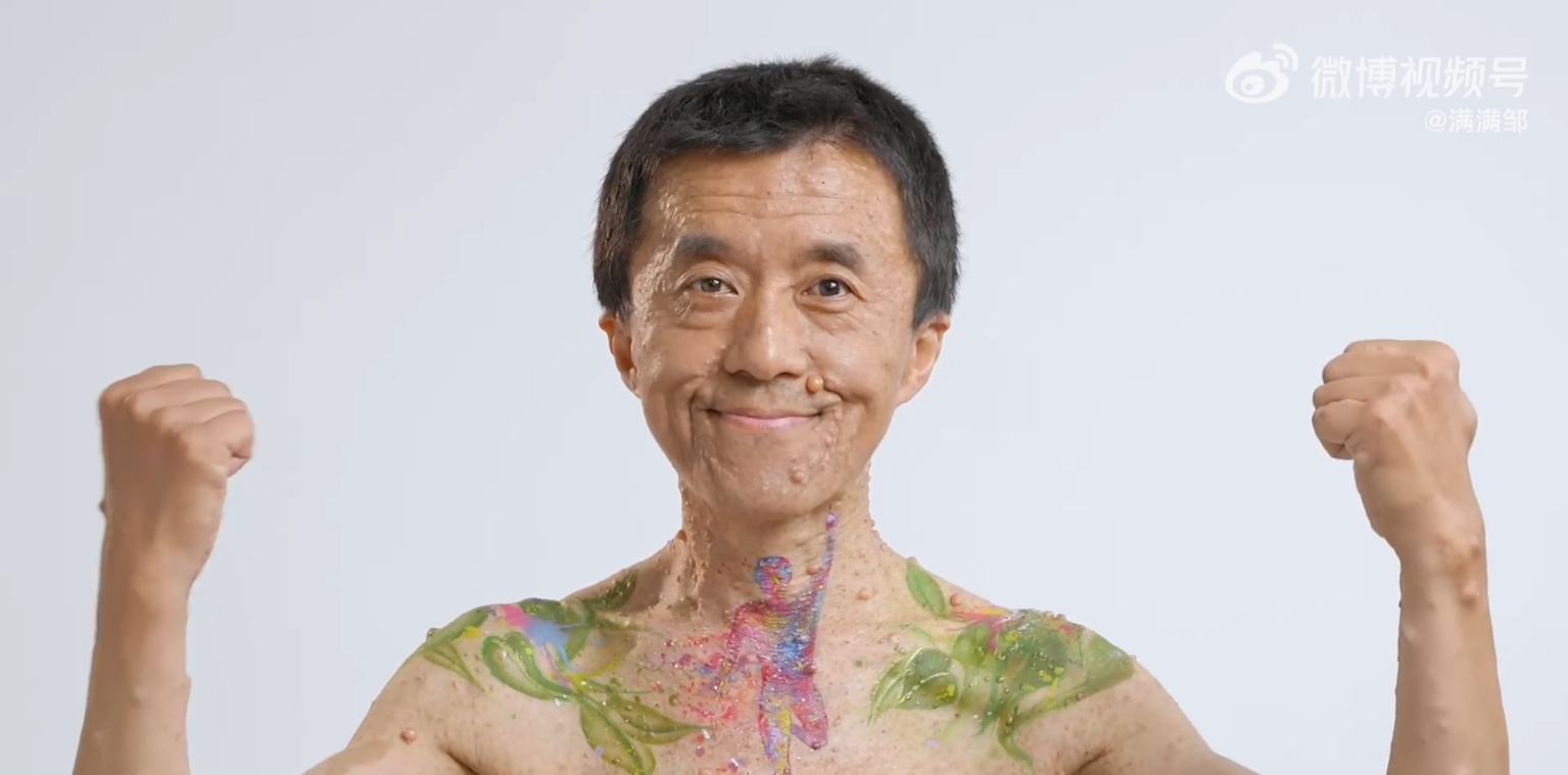 I型神经纤维瘤患者彩绘花絮