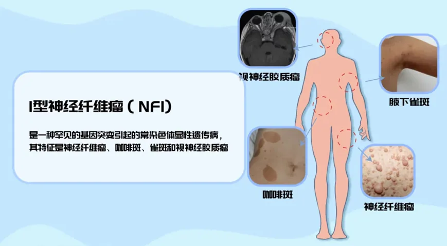 解放军总医院第三医学中心神经纤维瘤病专病门诊正式开诊
