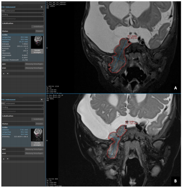 丝裂原活化蛋白激酶激酶抑制剂使6个月大婴儿面部丛状神经纤维瘤迅速显著缩小