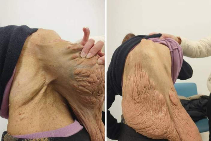 发病率仅三千分之一！背负7公斤巨瘤40年的她终于卸下“重担”