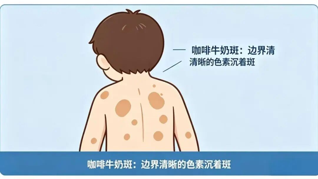 东南大学附属中大医院神经纤维瘤病专病门诊正式开诊