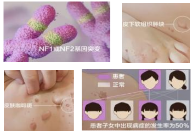 威海妇幼保健院I型神经纤维瘤义诊 报名中